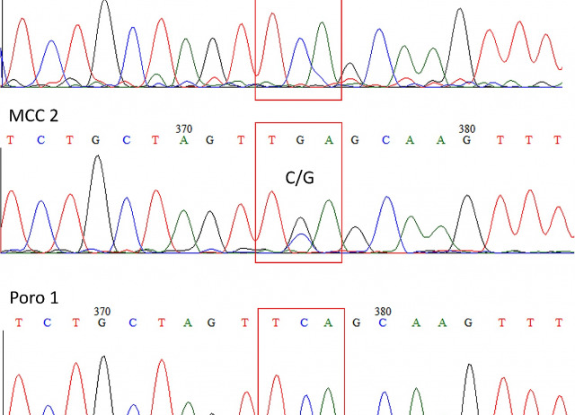 No detectable truncating mutations in large T antigen (LT-Ag) sequence of Merkel cell polyomavirus (MCPyV) DNA obtained from porocarcinomas